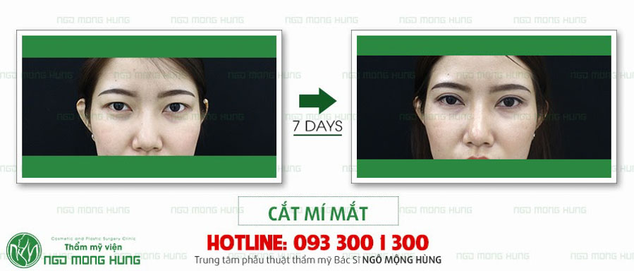 Hình ảnh khách hàng cắt mí mắt sau 7 ngày ở bệnh viện Ngô Mộng Hùng